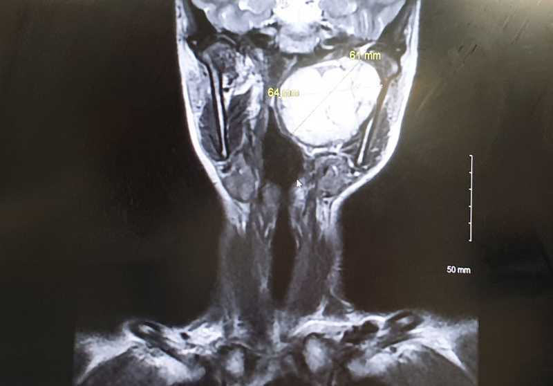 MRI scan